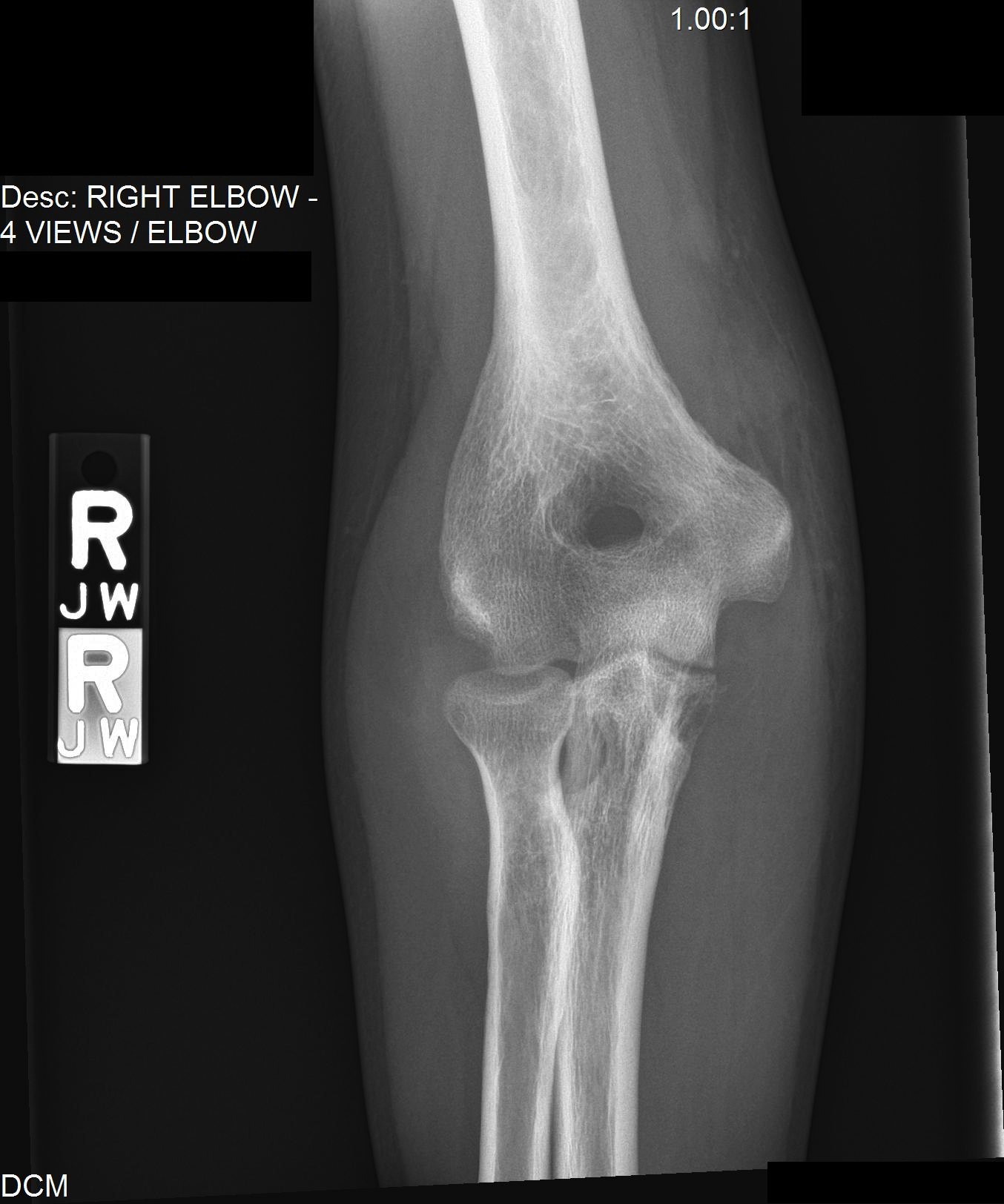 Articular Tuberculosis Affecting the Distal Humerus Consultant360